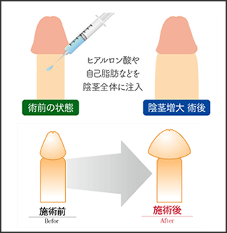 ペニス増大・陰茎増大手術（クリニックなどへの通院）